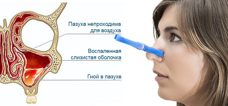 Процесс пазухе носа