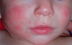 Аллергия может проявляться на лице