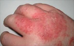 Высыпания на кисти — признак аллергии