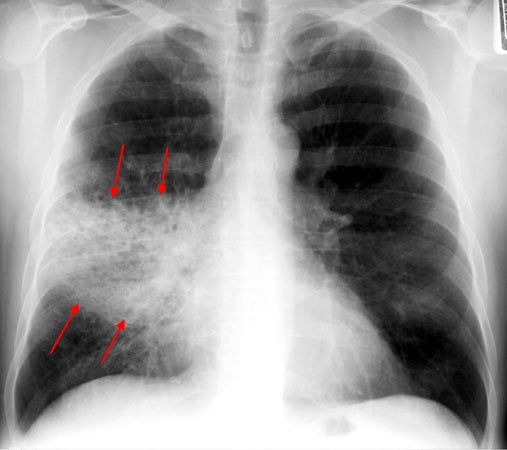 Для диагностики воспаления легких необходимо использовать рентген