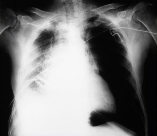 На рентгене видна картина заболевания