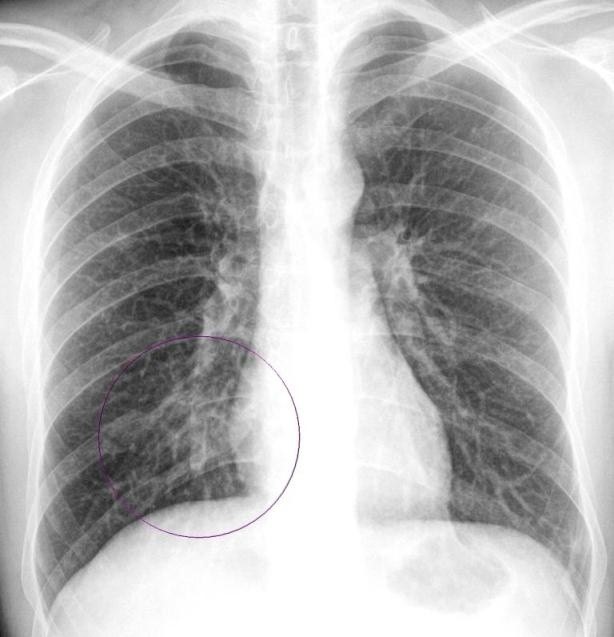 В диагностике пневмонии применяйте рентген
